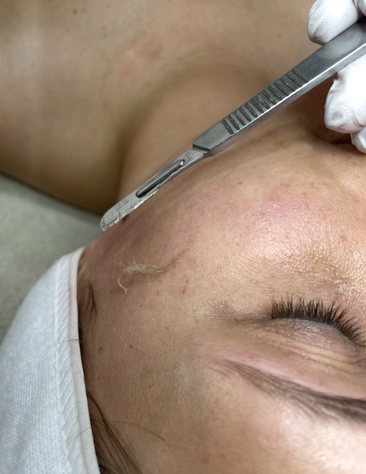 Dermaplanning